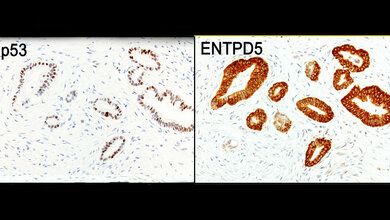 Ausschnitt_aus_einem_Bauchspeicheldruesen_Tumor_AG_Stiewe_Philipps_Universitaet_Marburg.jpg Ausschnitt aus einem Bauchspeicheldrüsen-Tumor