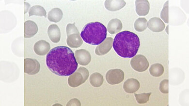 Blutausstrich_eines_Patienten_mit_ALL_Von_Christaras_A_Photographed_myself_CC_BY_2_5_wikimedia.jpg Blutausstrich eines Patienten mit ALL