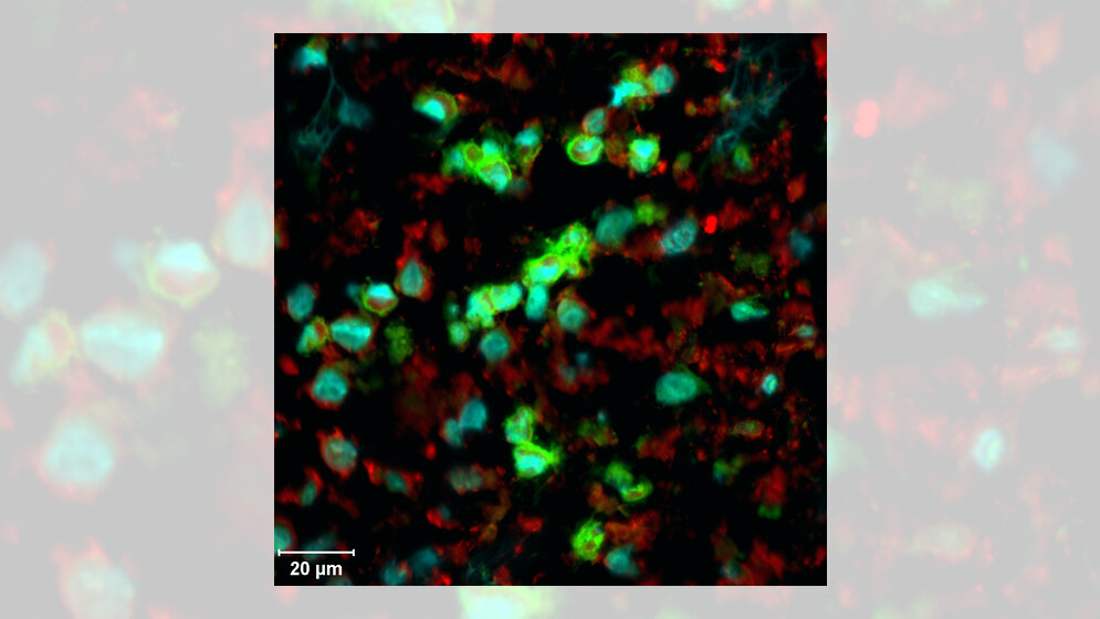LCH_Zellen_aus_einer_Tumorbiopsie__CeMM.jpg LCH-Zellen aus einer Tumorbiopsie