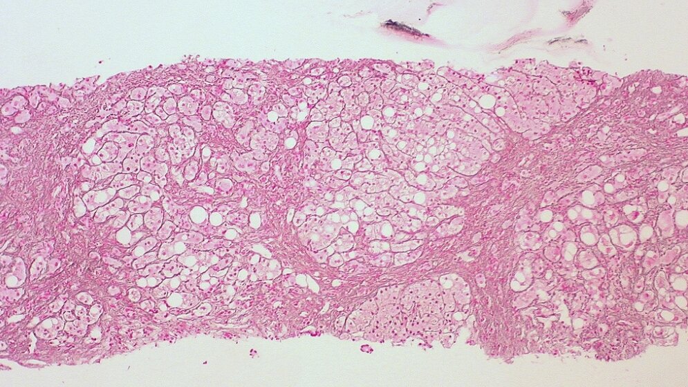 Leberzirrhose_Ed_Uthman_CC_BY_2_0_19042016.jpg Leberzirrhose