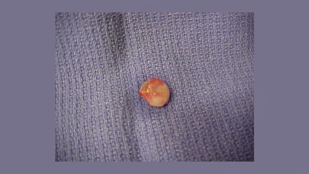 Leere_Zyste_von_der_Kopfhaut_einer_Frau_By_Northerncedar_talk_CC_BY_SA_3_0_Wikipedia.jpg Leere Zyste von der Kopfhaut einer Frau