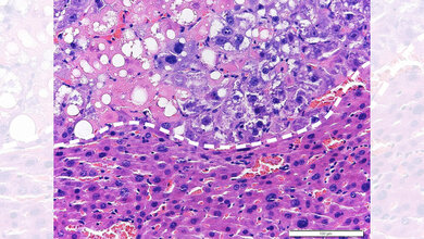 Lebertumor_unterm_Mikroskop_Daniel_Dauch_Uniklinikum_Tuebingen.jpg Lebertumor unterm Mikroskop