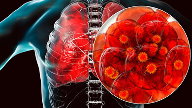 Auswirkungen von SARS-CoV-2 Symbolisches Bild, das SARS-CoV-2-Viren in der Lunge zeigt