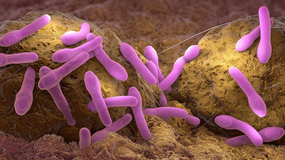 Magen-Botox.jpg Botulismus nach Magen-Botox: Zwölf Deutsche erkrankt