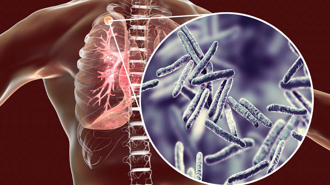 Tuberkulose_01.jpg Tuberkulose