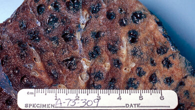 Raucherlunge_Dr_Edwin_P_Ewing_Jr_CDC__public_domain.jpg Raucherlunge