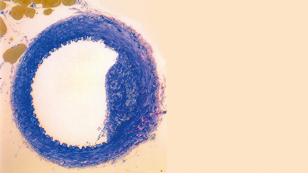 Laboratoriumsmedizin Risikofaktor Homocystein