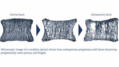 Osteoporose_obs_The_International_Osteoporosis_Foundation_IOF.jpg Osteoporose