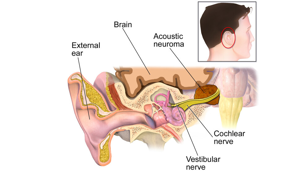 Schwannon.jpg Vestibularis-Schwannom