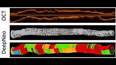 KI_OCT.jpg Es wird die Anwendung von DeepNeo gezeigt. Die untere Abbildung zeigt die Klassifizierung durch DeepNeo: Blau markiert nicht auswertbare Bereiche, Grün steht für homogene Neointima, Orange kennzeichnet heterogenes Gewebe, und Rot weist auf Neoatherosklerose hin.
