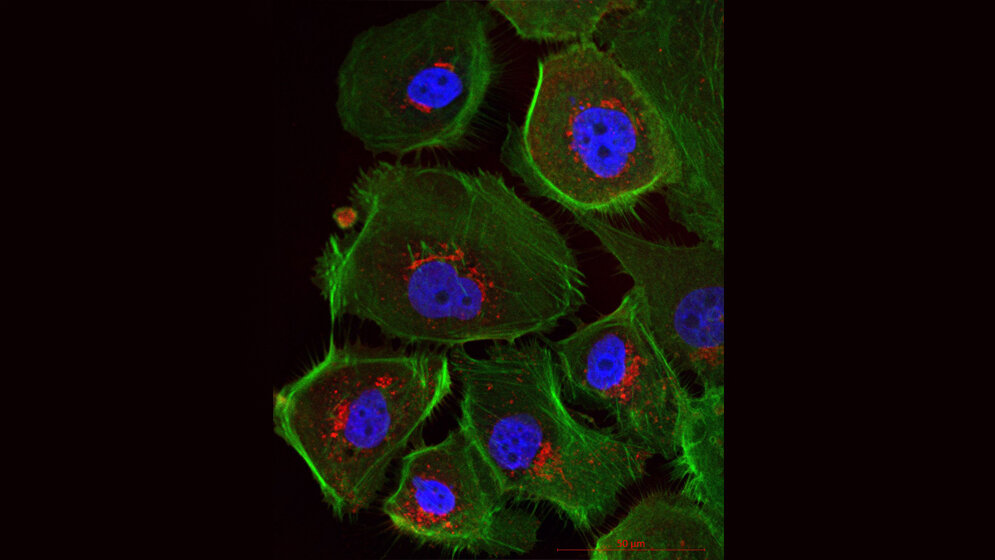 Mikroskopische_Ansicht_menschlicher_Eierstockkrebszellen_Klinik_für_Frauenheilkunde_Uniklinikum_Dresden.jpg Mikroskopische Ansicht menschlicher Eierstockkrebszellen