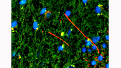 Zelltypen_MS-Laesionen.jpg Zelltypen MS-Läsionen