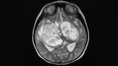 Aus der Forschung Strahlenempfindlichkeit von Hirntumorzellen