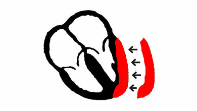 Schematische_Darstellung_der_Anwendung_von_schlagenden_Herzpflastern_fuer_den_Herzmuskelersatz_bei_Herzmuskelschwaeche_umg_zimmermann.jpg Herzmuskelersatz