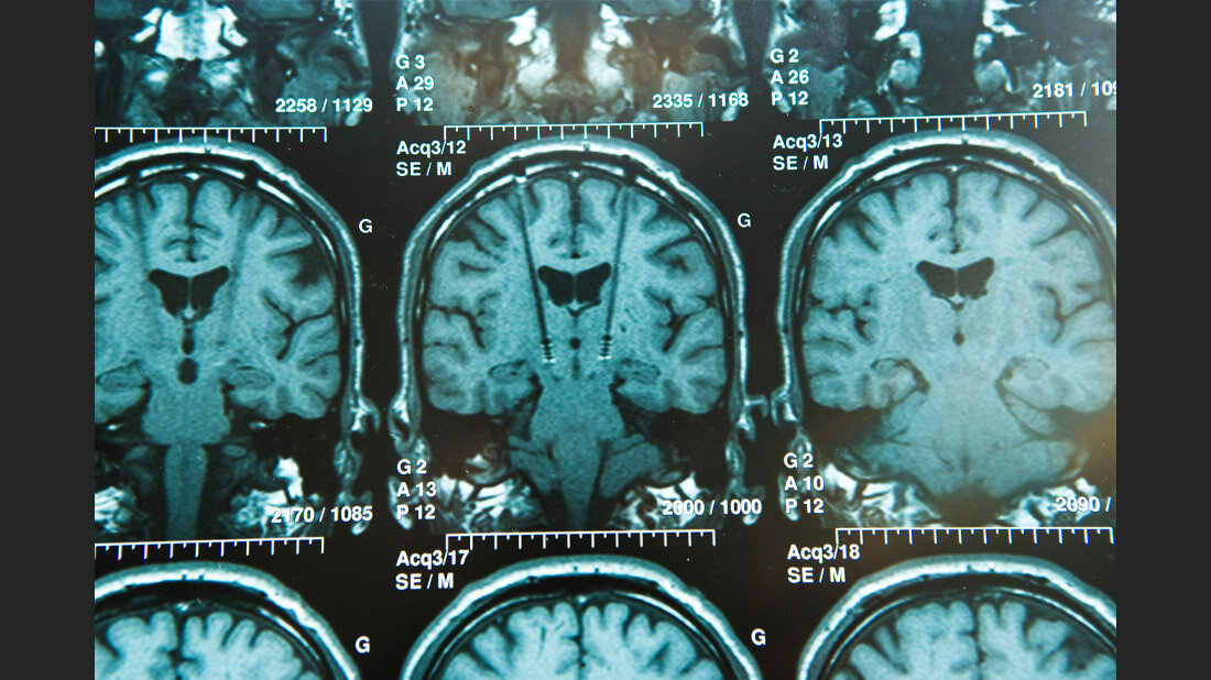 tiefe_Hirnstimulation_Adobe.jpg Gefahr durch Implantate im MRT verhindern