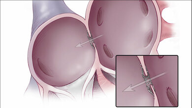 Linke_Vorkammer_rechts_und_rechten_Vorhof_unten_implantierte_Spange_zum_Offenbleiben_des_Verbindungskanals_Abbildung_Corvia_Medical_Inc_04052016.jpg implantierte Spange