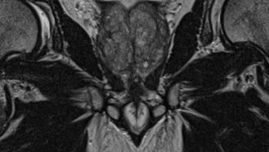 MRT_hochaufgeloeste_T2_coronarer_Ausrichtung_C_A_Stueckle.jpg Hochaufgelöste T2 in coronarer Ausrichtung