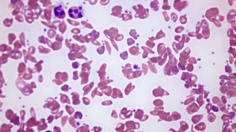 Blutausstrich_bei_Sichelzellanaemie_Rick_Jan_Kluitenberg_eigenes_Werk_CC_BY_SA_3_0_wikimedia.jpg Blutausstrich bei Sichelzellanämie