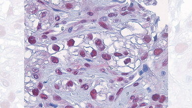 Blick_in_Tumorgewebe_des_malignen_Melanoms_Institute_of_Pharmacology_University_of_Bern.jpg Blick in Tumorgewebe des malignen Melanoms