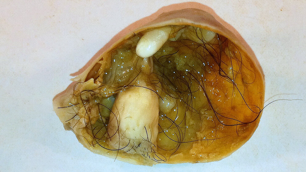 Bildgebende Verfahren Teratom
