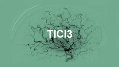 Reperfusion_nach_Gabe_von_Urokinase_Unispital_Bern.jpg Reperfusion nach Gabe von Urokinase