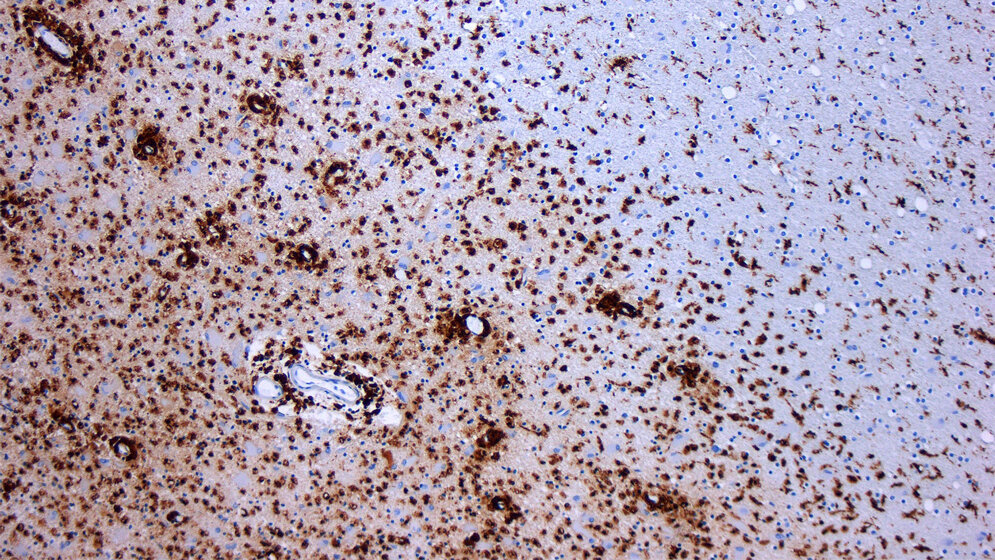 Demyelinisierung_bei_multipler_Sklerose_Quelle_Marvin_101_CC_BY_SA_3_0_Wikimedia_28102016.jpg Demyelinisierung bei MS