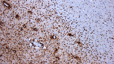 Demyelinisierung_bei_multipler_Sklerose_Quelle_Marvin_101_CC_BY_SA_3_0_Wikimedia_28102016.jpg Demyelinisierung bei MS