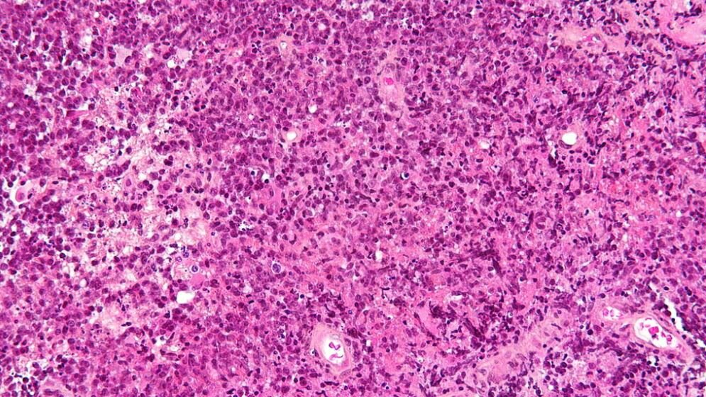 Primary_CNS_lymphoma_von_Nephron_CC_BY_SA_3_via_Wikimedia_Commons_23032016.jpg Primäres ZNS Lymphom