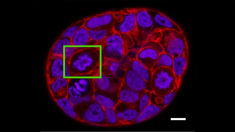 Mini_Tumor_aus_menschlichen_Brustkrebszellen_MCF_7_Dr_Elisabeth_Fischer_Friedrich.jpg Mini-Tumor aus menschlichen Brustkrebszellen
