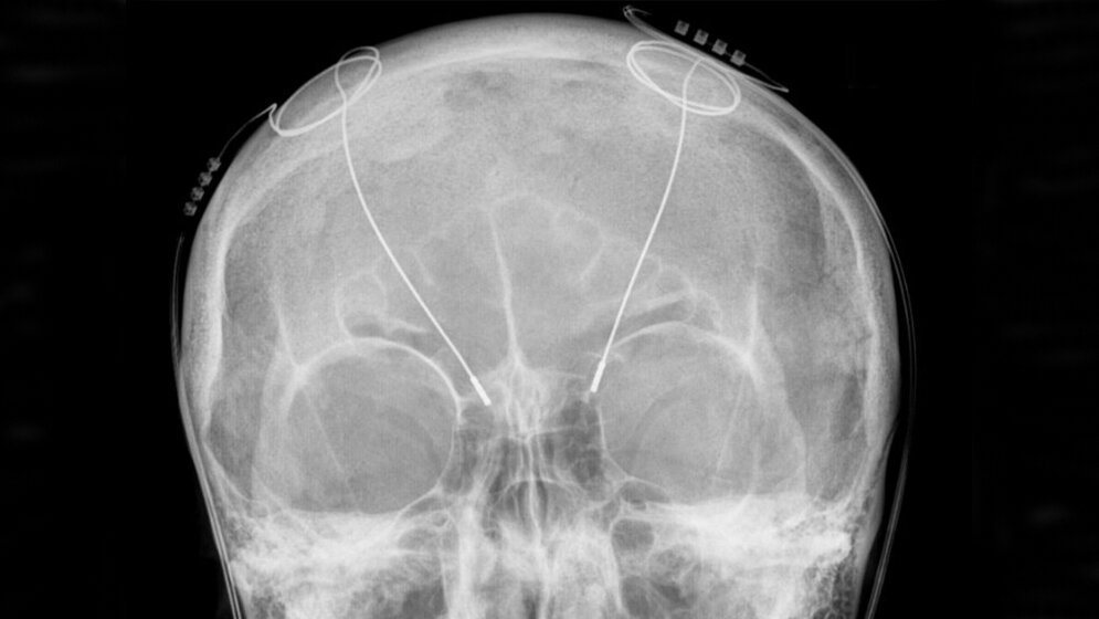 Tiefe_Hirnstimulation_Hellerhoff_Eigenes_Werk_CC_BY_SA_3_via_Wikimedia_Commons_08042016.jpg Tiefe Hirnstimulation