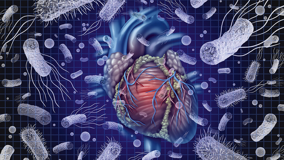 Verdacht auf Endokarditis Grafische Visualisierung einer Endokarditis