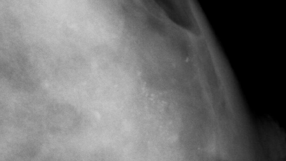 Mammographie_mikrokalk_von_MBq_CC_BY_SA_3_via_Wikimedia_Commons_23032016.jpg Mikrokalk in einer Mammographie