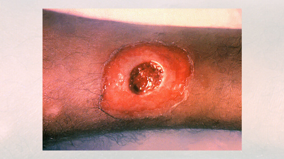 Hautdiphterie_CDC.jpg Eine diphtherische Hautläsion am Bein