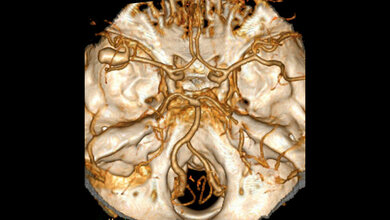 Aneurysma_der_A_cerebri_media_Hellerhoff_Eigenes_Werk_CC_BY_SA_3_0.jpg Aneurysma der A. cerebri media