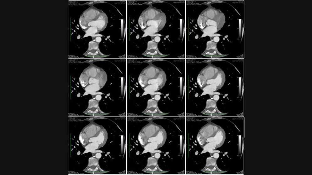 10 Schritte zur erfolgreichen Kardio-CT Untersuchung (Teil 2) Radiologische Diagnostik