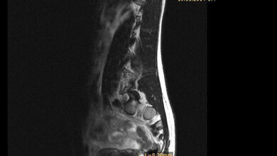 Bildgebende Verfahren Ovula Nabothi