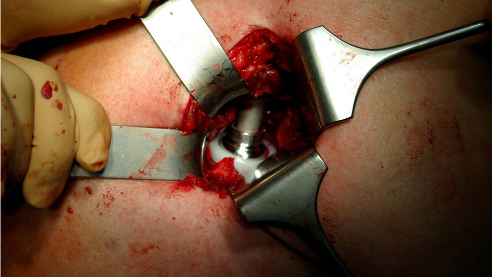 implantierte_Endoprothese_Dr_Ruprecht_von_Welser__Self_photographed_CC_BY_SA_2_0_de_wikimedia.jpg Minimal-invasive Hüftgelenk-Operation