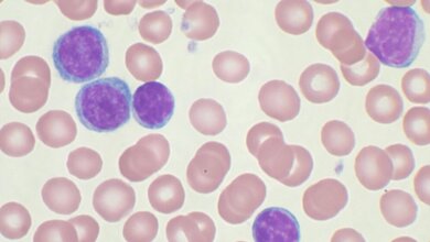 Chronic_lymphocytic_leukemia_Von_VashiDonsk_Wikipedia_CC_BY_SA_3_0_Ausschnitt_18042016.jpg CLL