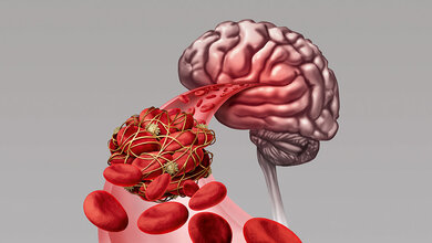 Time is Brain Grafische Darstellung eines Thrombus im Gehirn