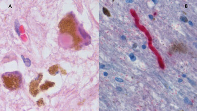 Histologische_Probe_von_Substantia_nigra_bei_Parkinson_Krankheit_Werner_CJ_et_al.jpg Histologische Probe von Substantia nigra