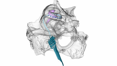 Optisches_Cochlea_Implantat_in_der_Hoerschnecke_einer_Wuestenrennmaus_Prof_Salditt_Uni_Goettingen.jpg Optisches Cochlea Implantat in der Hörschnecke einer Wüstenrennmaus