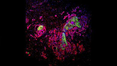 Gewebeanalyse_eines_am_Pankreaskarzinom_erkrankten_Patienten_UMM.jpg Gewebeanalyse eines am Pankreaskarzinom erkrankten Patienten
