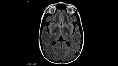 MRT_axiales_FLAIR_zeigt_erhoetes_T2_Signal_Frank_Gaillard_CC_BY_SA_3_0_Wikimedia_Commons.jpg MRT (axiales FLAIR)