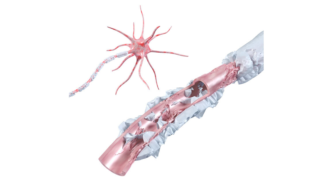 Nervenschaeden.jpg Nervenschäden