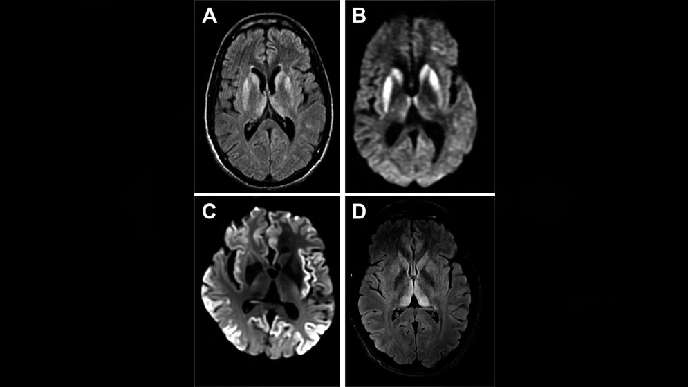 MRT_der_sporadischen_CJK_Pract_Neurol_DOI_10_1136_practneurol_2016_001571.jpg MRT der sporadischen CJK