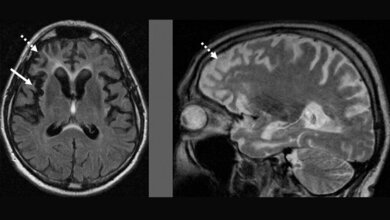 MRT_eines_Patienten_mit_Frontotemporaler_Demenz_Synofzik_2017.jpg MRT eines Patienten mit Frontotemporaler Demenz