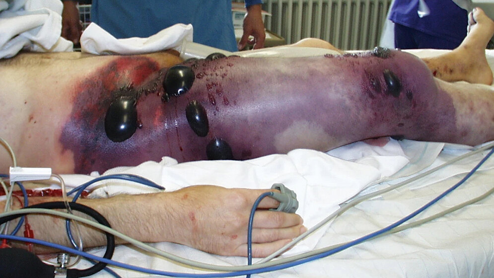 Laboratoriumsmedizin Gasbrand