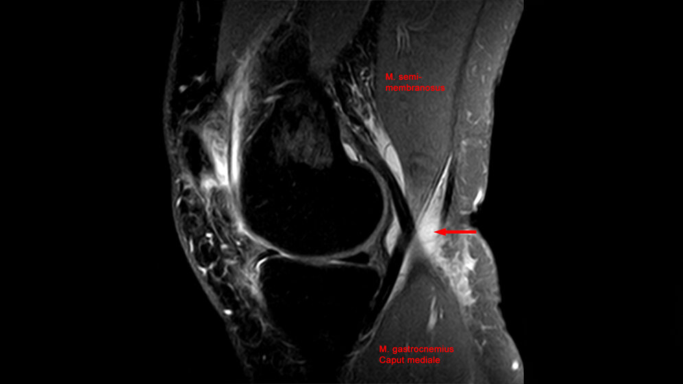 Bakerzyste_in_der_MRT_Hellerhoff_eigenes_Werk_CC_BY_SA_3_0_wikimedia.jpg Baker-Zyste in der MRT