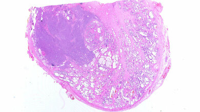 Prostata_mit_Adenokarzinom_Alex_brollo_CC_BY_SA_3_0_wikimedia.jpg Prostata mit Adenokarzinom