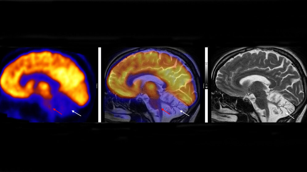 Stoffwechselaktivitt_des_Gehirns_links_PET_und_Struktur_rechts_MRT_sowie_die_UEberlagerung_beider_Bilder_bei_Patienten_mit_SYNE1_Erkrankung_Dr_Mona_Mustafa_LMU_Muenchen_23052016.jpg Stoffwechselaktivität des Gehirns